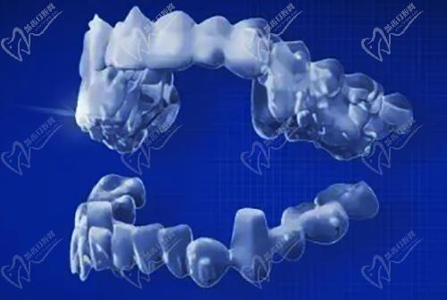 正雅GS版隐形矫正器