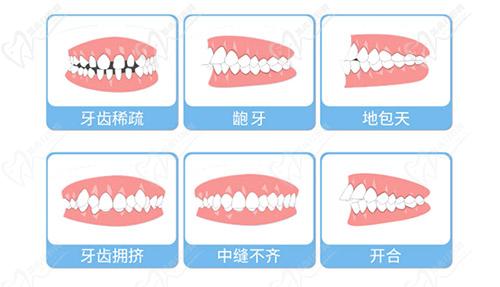 牙齿不齐