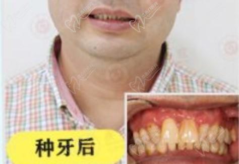 广州广大口腔种植牙