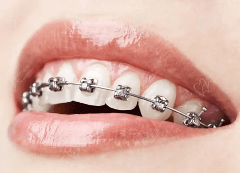 厦门思明优梨口腔李志牙齿矫正