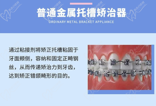 金属托槽矫正优势有哪些