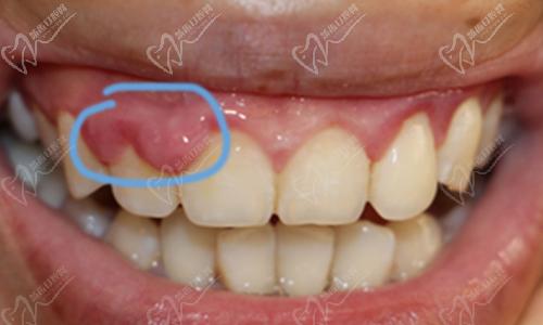 牙龈癌图片晚期 x光片图片