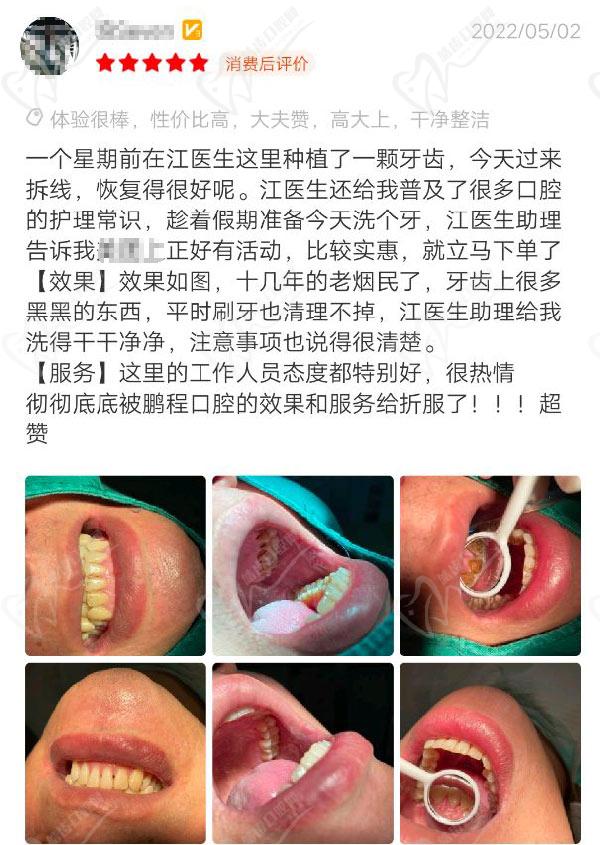 深圳鹏程医院口腔科种植牙点评