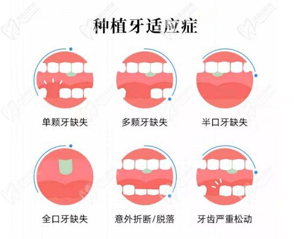 种植牙适用人群