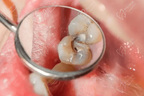 龋齿一定及时补