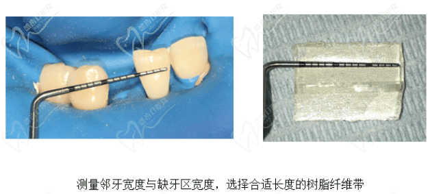 树脂粘接桥（过渡性义齿）修复