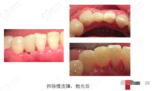 牙齿修复后照片