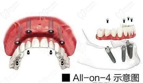 All-on-4种植牙示意图