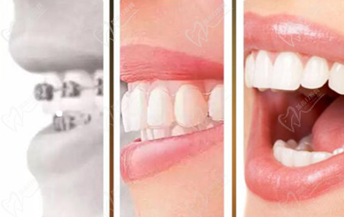 牙齿矫正 牙齿矫正