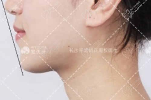 长沙牙大夫口腔周权院长正畸病例