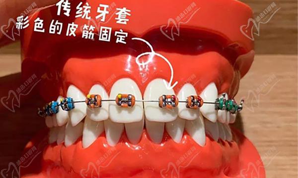 金属托槽矫正