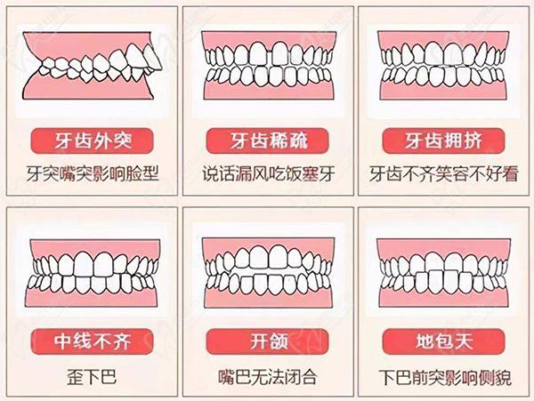 牙齿畸形情况及影响