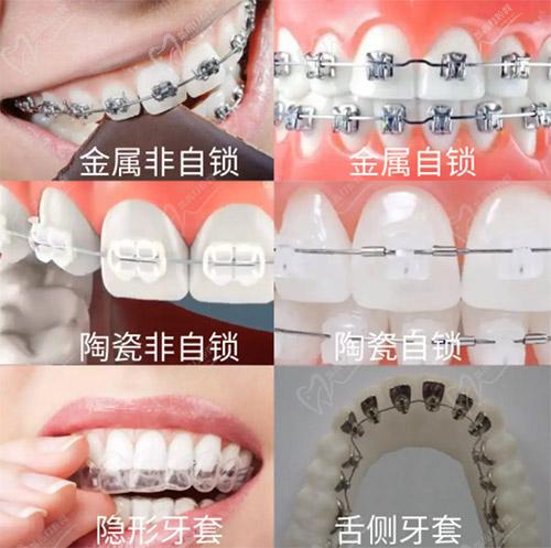 牙齿矫正牙套种类