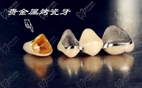 根管治疗烤瓷牙冠