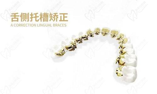 舌侧托槽矫正