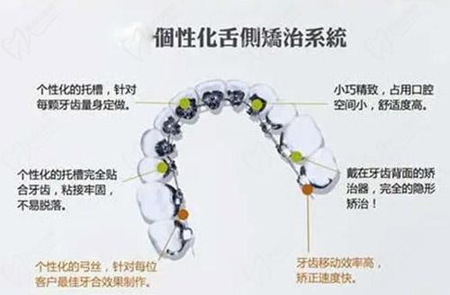 舌侧矫正系统