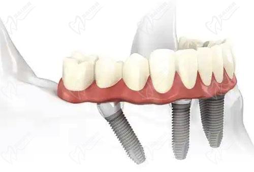 all-on-4牙齿种植技术