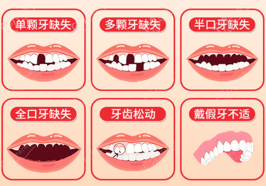 韩国奥齿泰种植牙适应症