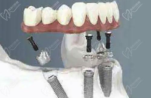all-on-4牙齿种植技术