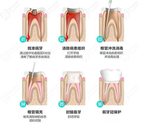 根管治疗