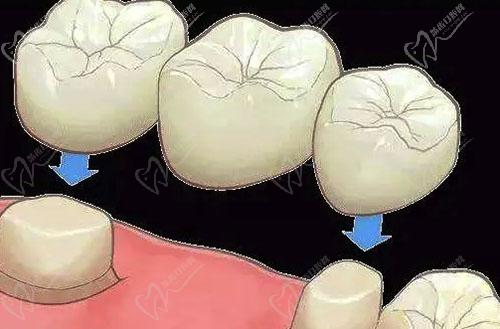 牙冠使用示范图