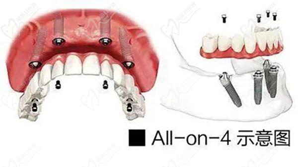 all-on-4/6全口种植牙