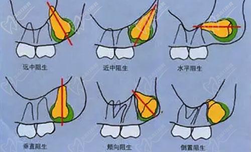 需要拔除的智齿类型有哪些