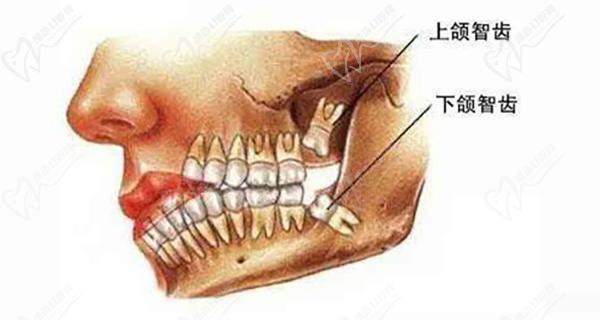 上下颌智齿