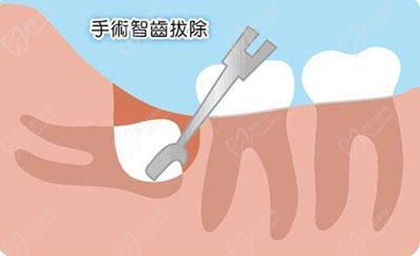 拔智齿手术示意