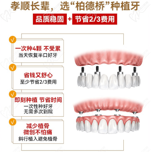 广州柏德口腔ALL-ON-4半口种植牙优势