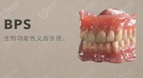 BPS吸附性义齿