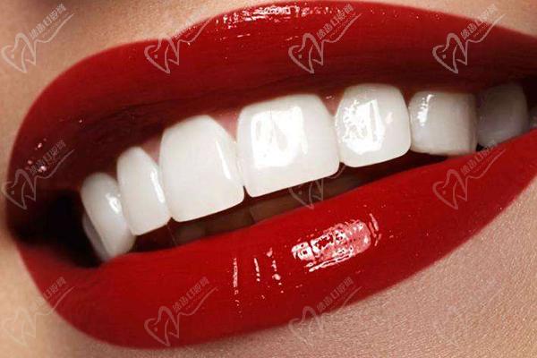 牙齿美白美容修复方式——牙贴面