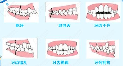 牙齿错颌畸形种类