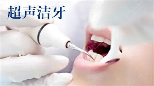宁波口腔医院洗牙收费标准
