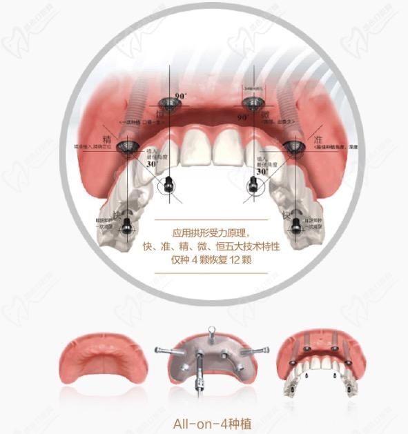 南宁诺贝尔口腔ALL-ON-4种植牙