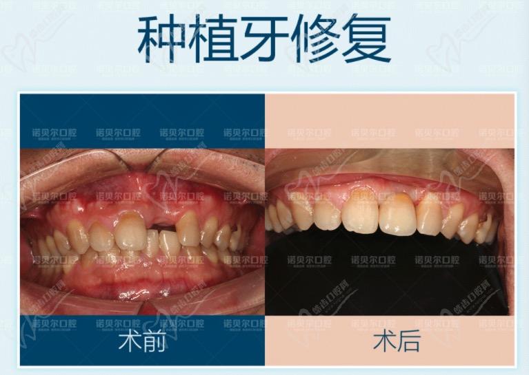 南宁诺贝尔口腔医院种植牙病例