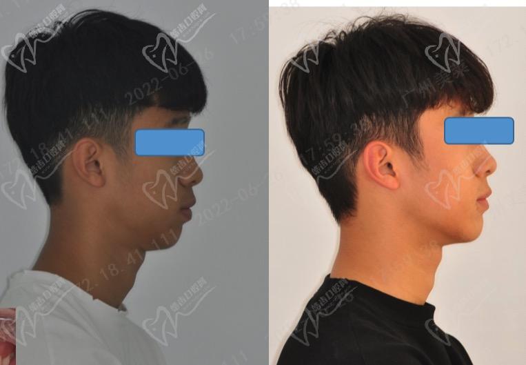 广州美莱口腔正畸病例