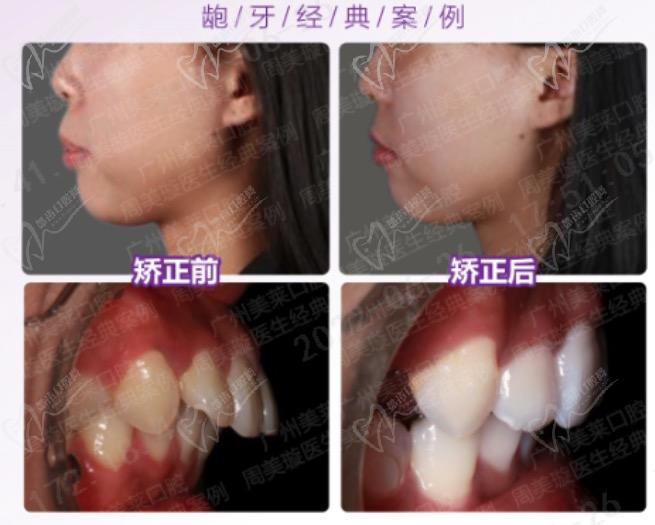 广州美莱口腔周美璇医生矫正病例