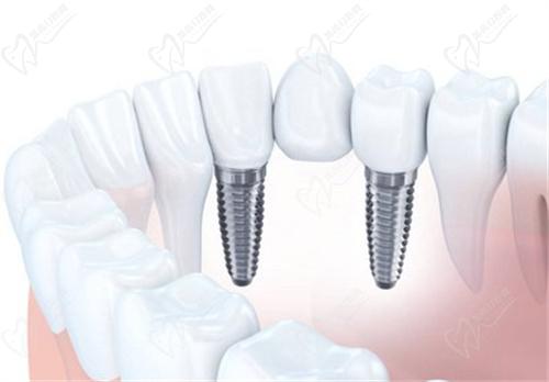 种植牙示意图 种植牙示意图