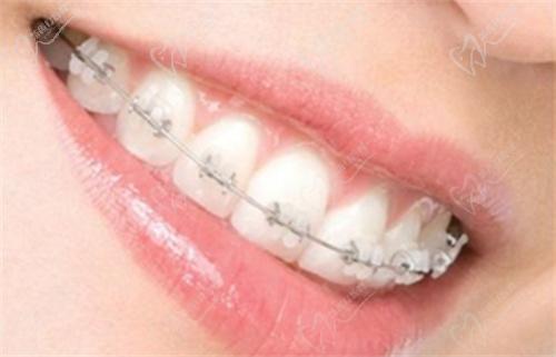 牙齿矫正示意图 牙齿矫正示意图