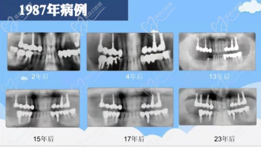 上海罗缘口腔医院种植牙怎么样