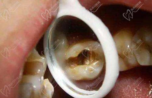 当龋洞内长有息肉时,可能是牙髓息肉,牙龈息肉或牙周息肉,牙友们一定