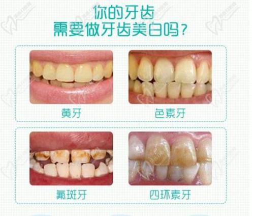皓齿美白