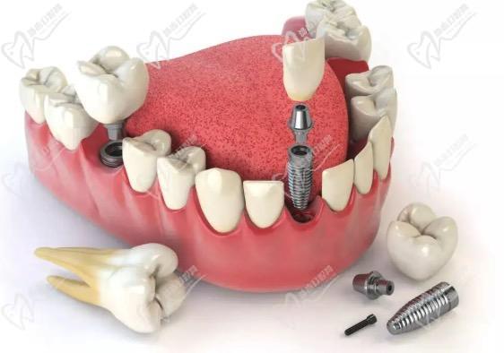 微创即刻种植牙