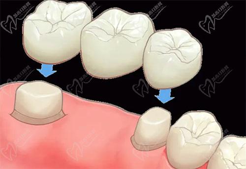 口腔桥体分类图片图片