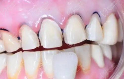 牙贴面有什么后遗症吗