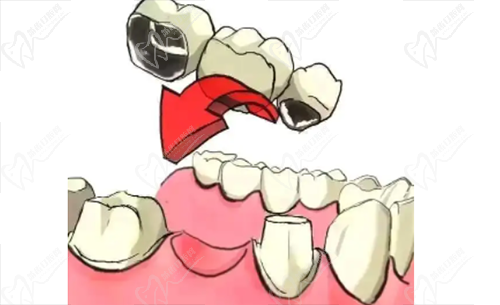 镶牙