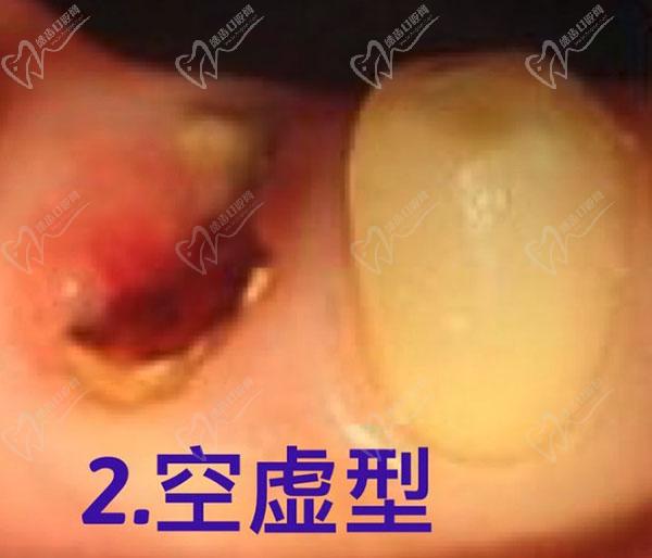 干槽症的症状
