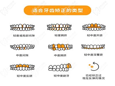 适合牙齿矫正的类型
