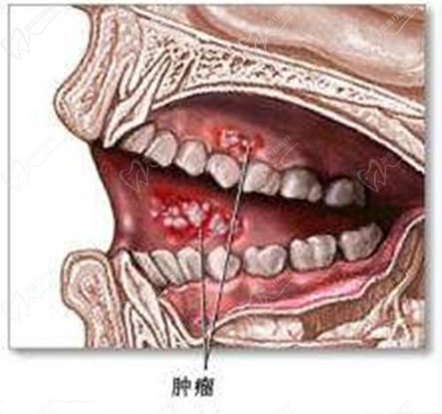 牙龈癌